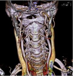 3D of Carotid and Vertebral Arteries - CTisus CT Scan