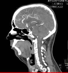 3D of Carotid and Vertebral Arteries - CTisus CT Scan