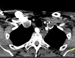 Aneurysms of Subclavian Arteries - CTisus CT Scan