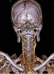 Circle of Willis - CTisus CT Scan