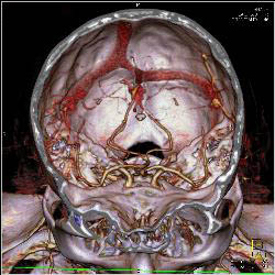 Circle of Willis - CTisus CT Scan