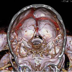 Circle of Willis - CTisus CT Scan