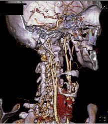 Carotid Bifurcation and Vertebral Artery Aneurysm - CTisus CT Scan