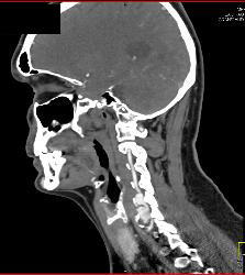 Vertebral Artery Aneurysm - CTisus CT Scan