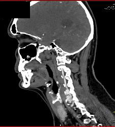 artery vertebral aneurysm ctisus neuro