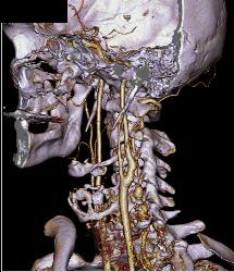 Vertebral Artery Aneurysm - CTisus CT Scan