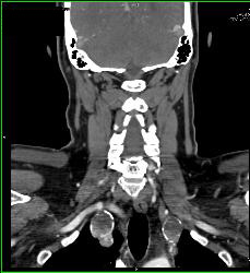 Subclavian Artery Aneurysm - CTisus CT Scan