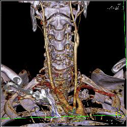 Subclavian Artery Aneurysm - CTisus CT Scan