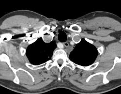 Subclavian Artery Aneurysm - CTisus CT Scan