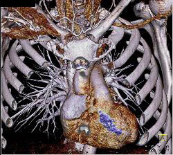 Subclavian Artery Aneurysm - CTisus CT Scan