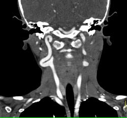 Ectatic Carotid Arteries in Loeys-Dietz Syndrome - CTisus CT Scan