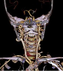 Ectatic Carotid Arteries in Loeys-Dietz Syndrome - CTisus CT Scan