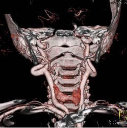 Ectatic Carotid Arteries in Loeys-Dietz Syndrome - CTisus CT Scan