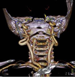 Ectatic Carotid Arteries in Loeys-Dietz Syndrome - CTisus CT Scan