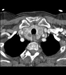 Thyroid Goiter - CTisus CT Scan