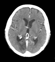 Infarct - CTisus CT Scan