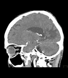 Infarct - CTisus CT Scan