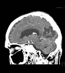 Infarct - CTisus CT Scan