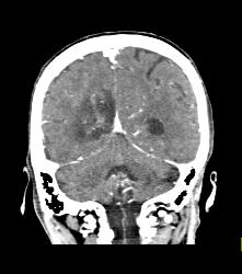 Infarct - CTisus CT Scan