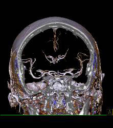 Infarct - CTisus CT Scan