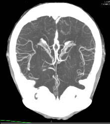 Infarct - CTisus CT Scan