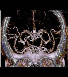 Infarct - CTisus CT Scan