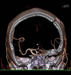 Infarct - CTisus CT Scan