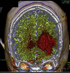 Infarct - CTisus CT Scan