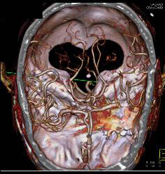 Infarct - CTisus CT Scan