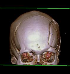 Craniotomy - CTisus CT Scan