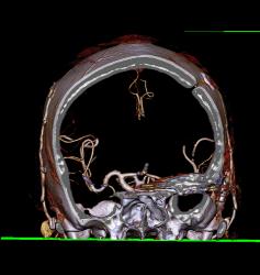 Craniotomy - CTisus CT Scan