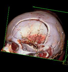 Craniotomy - CTisus CT Scan