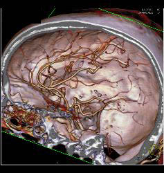 Craniotomy - CTisus CT Scan