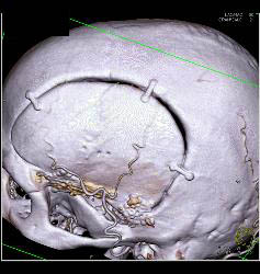 Craniotomy - CTisus CT Scan