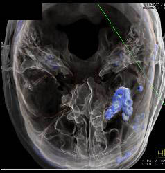 3D of Temporal Bone - CTisus CT Scan