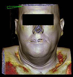 3D of Lytic Lesion in the Mandible Which Was Ameloblastoma - CTisus CT Scan