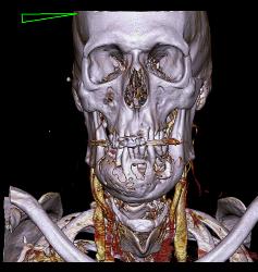 3D of Lytic Lesion in the Mandible Which Was Ameloblastoma - CTisus CT Scan