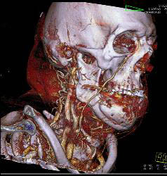 3D of Lytic Lesion in the Mandible Which Was Ameloblastoma - CTisus CT Scan