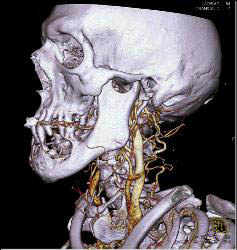 3D of Lytic Lesion in the Mandible Which Was Ameloblastoma - CTisus CT Scan