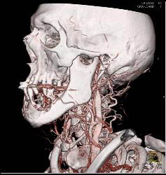 3D of Lytic Lesion in the Mandible Which Was Ameloblastoma - CTisus CT Scan