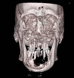 3D of Lytic Lesion in the Mandible Which Was Ameloblastoma - CTisus CT Scan