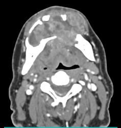 3D of Lytic Lesion in the Mandible Which Was Ameloblastoma - CTisus CT Scan