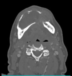 3D of Lytic Lesion in the Mandible Which Was Ameloblastoma - CTisus CT Scan