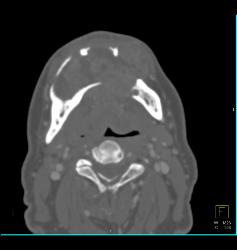 3D of Lytic Lesion in the Mandible Which Was Ameloblastoma - CTisus CT Scan