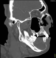 Ameloblastoma - CTisus CT Scan