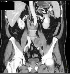 Schwannoma - CTisus CT Scan