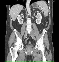 Schwannoma - CTisus CT Scan