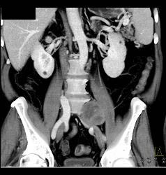 Schwannoma - CTisus CT Scan