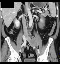 Schwannoma - CTisus CT Scan