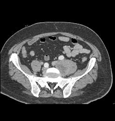 Schwannoma - CTisus CT Scan